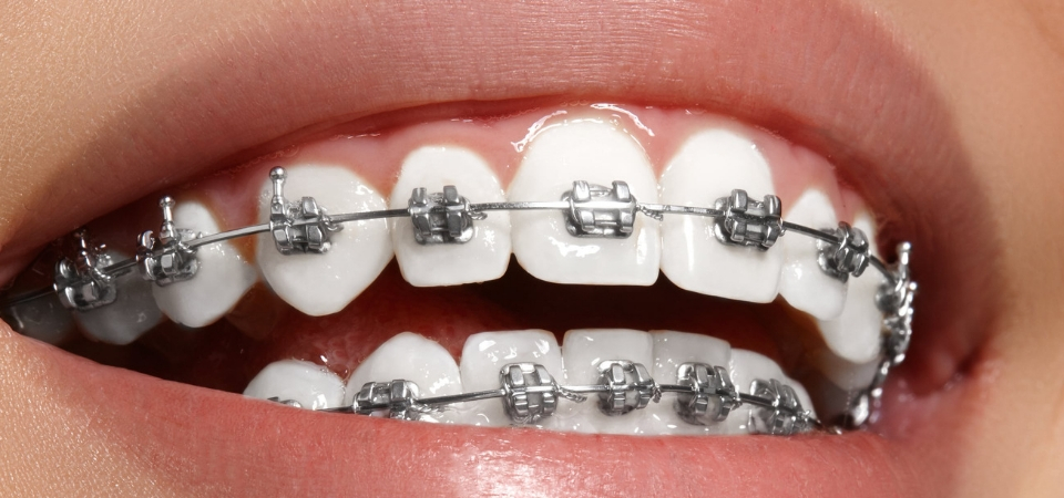 Clear Aligners: Better Replacement to Braces