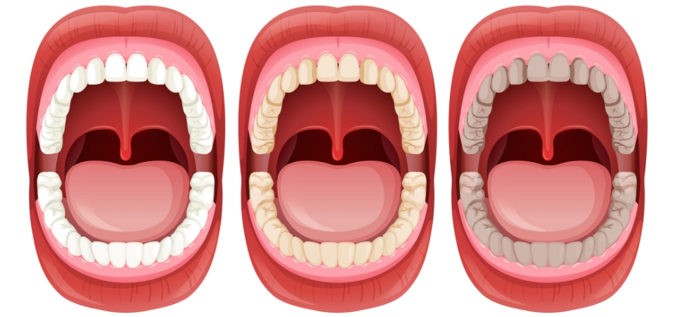 Five Signs that Prove your Oral Health is Worsening